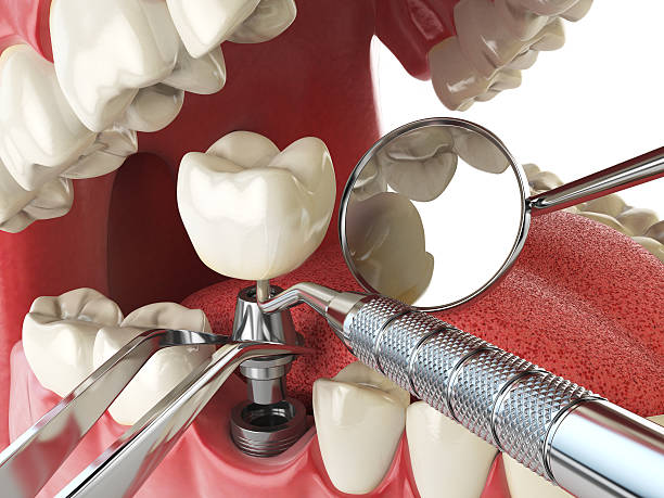 Best Emergency Root Canal Treatment in Woodburn, OR